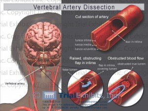 1368_Vertebral_Artery_Dissection