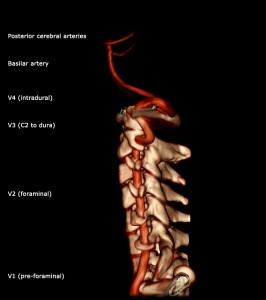 Vertebral_artery_3D_Lateral